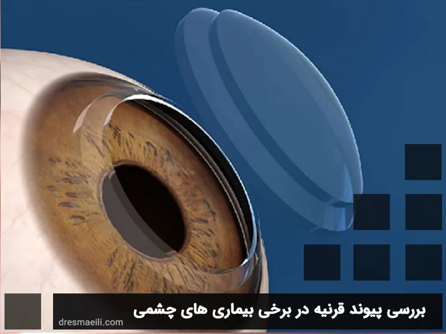 همه چیز دربارهی پیوند قرنیه - دکتراسماعیلی