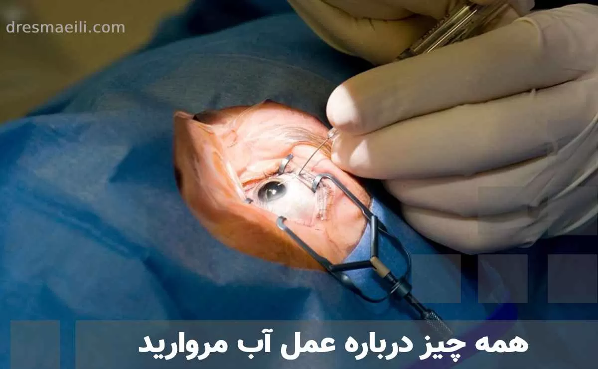 همه چیز درباره عمل آب مروارید
